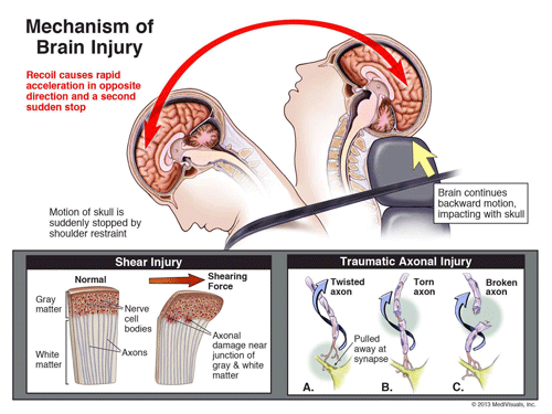 Brain Injury diagram